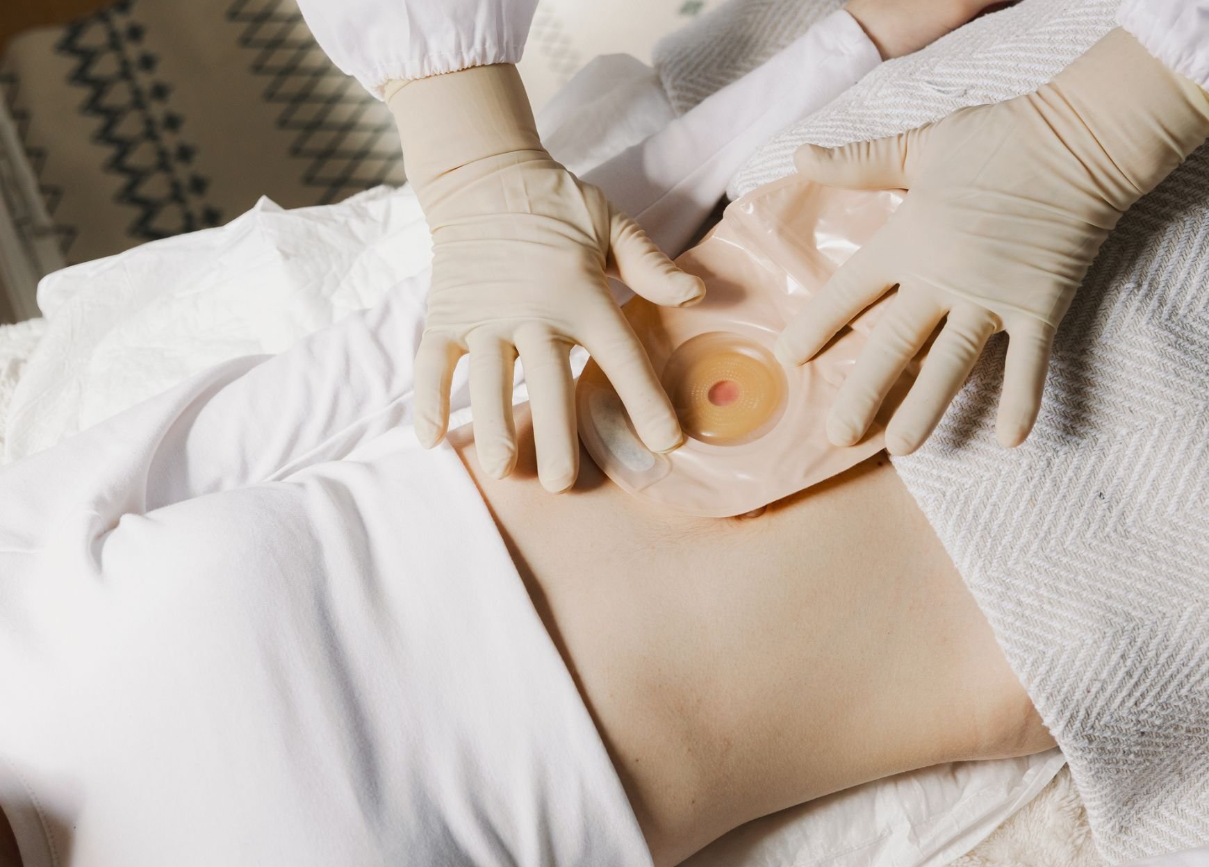 medical - Customized stoma care products